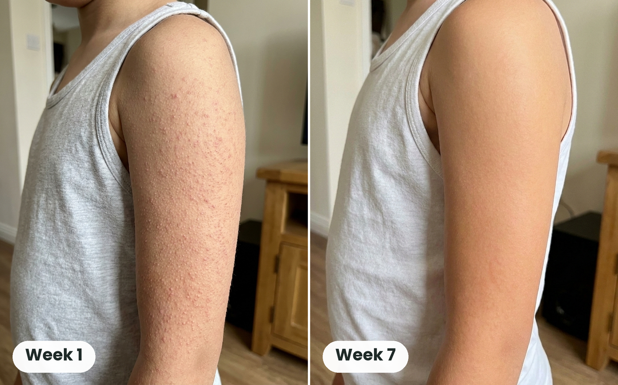 Soft, Smooth Arms Again in 4 to 12 Weeks: The Gentle Cream That Fixes Both Halves of Bumpy Skin 31 Customer before and after, Week 1 and Week 7