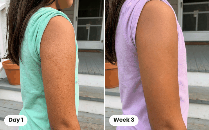 Soft, Smooth Arms Again in 4 to 12 Weeks: The Gentle Cream That Fixes Both Halves of Bumpy Skin 34 Customer before and after, Day 1 and Week 3
